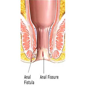 Fissure In Ano (Anal Fissure)